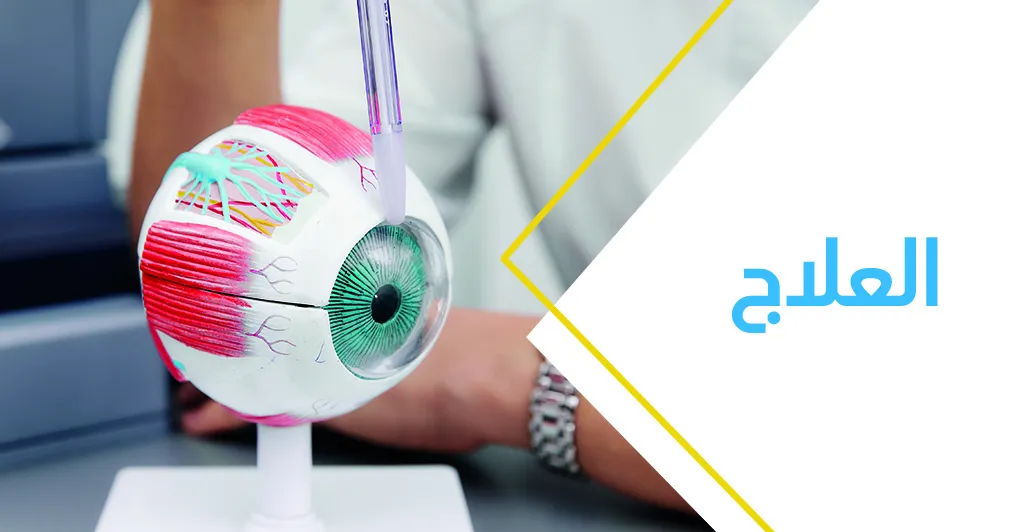 المياه البيضاء في العين وكيفيّة علاجها